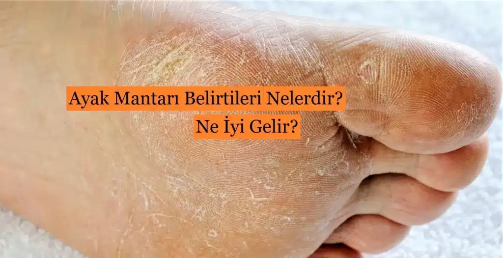 Ayak Mantarı Nedir? Belirtileri Nelerdir? Ayak Bakımı